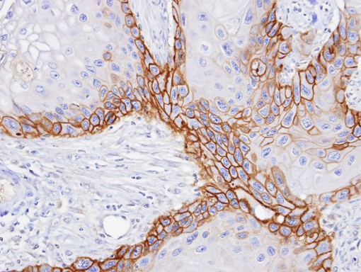 SLC3A2 / CD98 Heavy Chain Antibody - IHC of paraffin-embedded SCC15 xenograft using CD98 antibody at 1:100 dilution.
