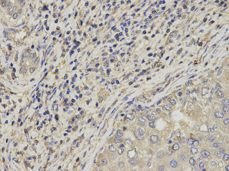 SLC4A4 / NBC1 Antibody - Immunohistochemistry of paraffin-embedded human liver cancer using SLC4A4 antibody at dilution of 1:200 (400x lens).