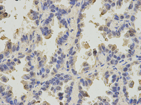 SLC4A4 / NBC1 Antibody - Immunohistochemistry of paraffin-embedded human lung cancer using SLC4A4 antibody at dilution of 1:200 (400x lens).