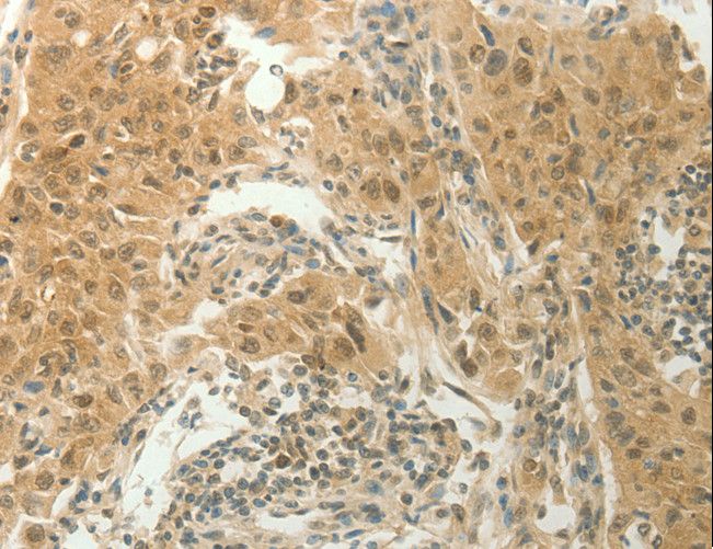 SLC8A3 / NCX3 Antibody - Immunohistochemistry of paraffin-embedded Human lung cancer using SLC8A3 Polyclonal Antibody at dilution of 1:70.