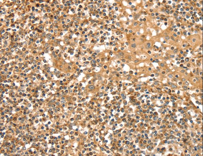 SLC8A3 / NCX3 Antibody - Immunohistochemistry of paraffin-embedded Human cervical cancer using SLC8A3 Polyclonal Antibody at dilution of 1:35.