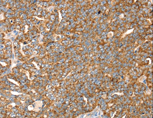 SLC8A3 / NCX3 Antibody - Immunohistochemistry of paraffin-embedded Human cervical cancer using SLC8A3 Polyclonal Antibody at dilution of 1:35.