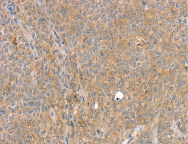 SLC8A3 / NCX3 Antibody - Immunohistochemistry of paraffin-embedded Human lung cancer using SLC8A3 Polyclonal Antibody at dilution of 1:35.