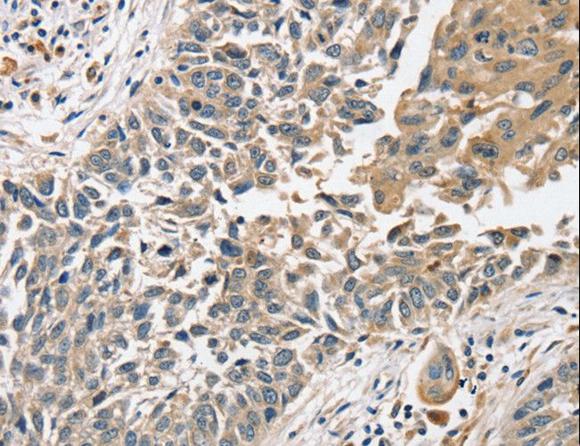 SLC8A3 / NCX3 Antibody - Immunohistochemistry of paraffin-embedded Human lung cancer using SLC8A3 Polyclonal Antibody at dilution of 1:35.