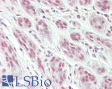 SNRPD3 Antibody - Human Breast: Formalin-Fixed, Paraffin-Embedded (FFPE)