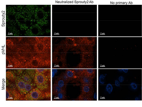 SPRY2 / Sprouty 2 Antibody - Immunohistochemistry of Rabbit anti-Sprouty2 antibody. Tissue: human kidney clear cell tumor. Fixation: formalin fixed, paraffin embedded. Antigen retrieval: yes. Primary antibody: Sprouty2 antibody at 1:250. Secondary antibody: Alexa Fluoro 488 secondary at 1:500 overnight at 4C. Localization: nucleus and cytoplasm. Staining: green = sprouty2, Blue = DAPI, red= VHL.