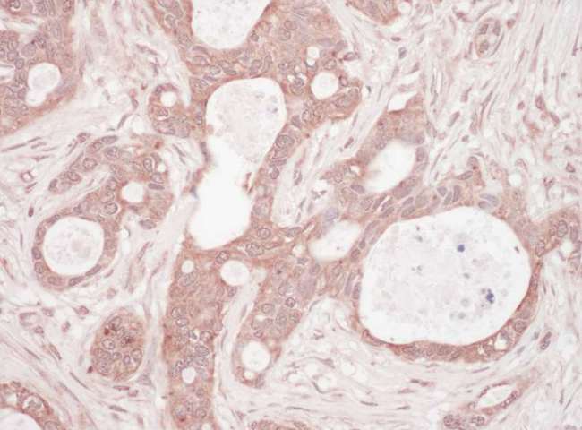 SQSTM1 Antibody - Detection of Human Sequestosome-1 by Immunohistochemistry. Sample: FFPE section of human breast carcinoma. Antibody: Affinity purified rabbit anti-Sequestosome-1 used at a dilution of 1:1000 (1 ug/ml). Detection: Vector Laboratories ImmPACT NovaRED Peroxidase Substrate.