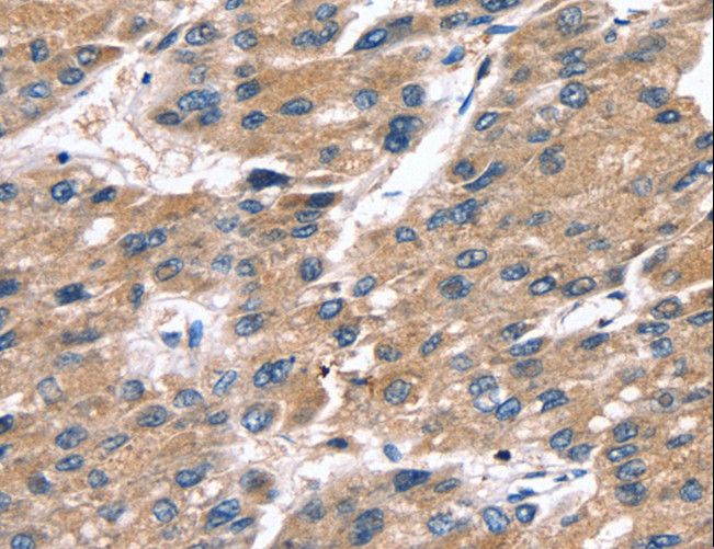 SRGN / Serglycin Antibody - Immunohistochemistry of paraffin-embedded Human liver cancer using SRGN Polyclonal Antibody at dilution of 1:25.