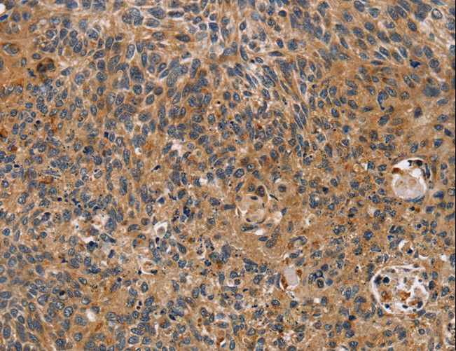 TAC1  Antibody - Immunohistochemistry of paraffin-embedded Human cervical cancer using TAC1 Polyclonal Antibody at dilution of 1:25.