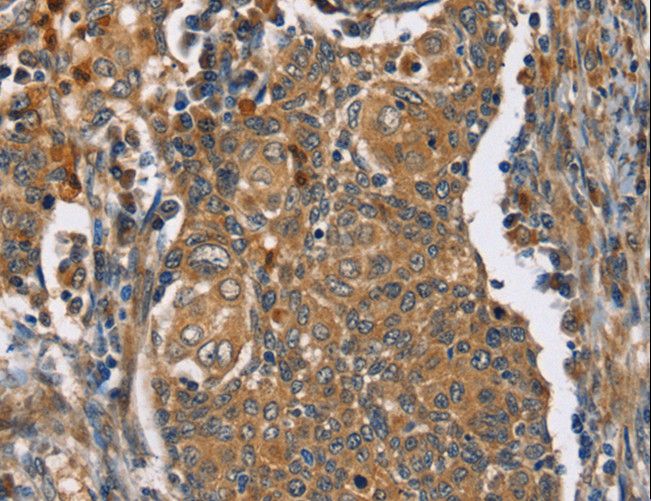 TAC1  Antibody - Immunohistochemistry of paraffin-embedded Human cervical cancer using TAC1 Polyclonal Antibody at dilution of 1:25.