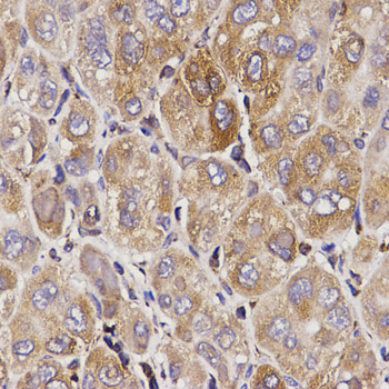 TAP2 Antibody - Immunohistochemistry of paraffin-embedded human liver cancer using TAP2 antibody at dilution of 1:200 (x400 lens).