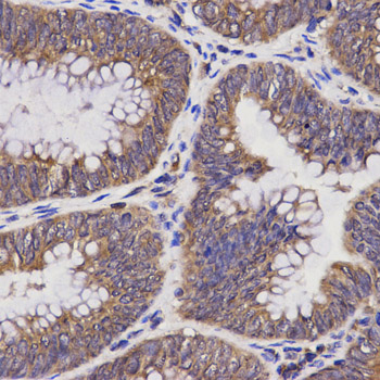 TAP2 Antibody - Immunohistochemistry of paraffin-embedded human rectal cancer using TAP2 antibody at dilution of 1:200 (x400 lens).