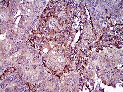 THY1 / CD90 Antibody - IHC of paraffin-embedded endometrial cancer tissues using THY1 mouse monoclonal antibody with DAB staining.