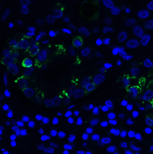 TIGIT Antibody - Immunofluorescence of TIGIT in human stomach carcinoma tissue using TIGIT Antibody at 5 ug/ml. Green: TIGIT Antibody [3B5] Blue: DAPI staining