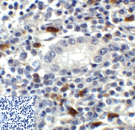 TIGIT Antibody - Immunohistochemistry of TIGIT in human stomach carcinoma tissue using TIGIT Antibody and control mouse IgG (corner box) at 2 ug/ml.