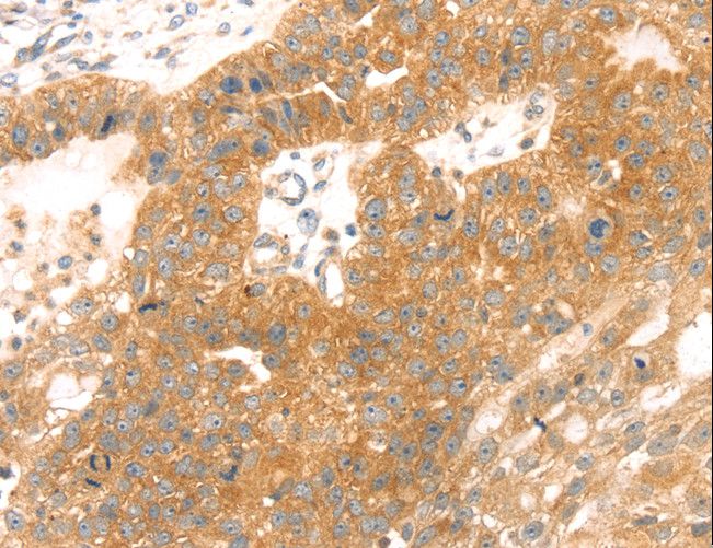 TMEFF2 Antibody - Immunohistochemistry of paraffin-embedded Human breast cancer using TMEFF2 Polyclonal Antibody at dilution of 1:35.