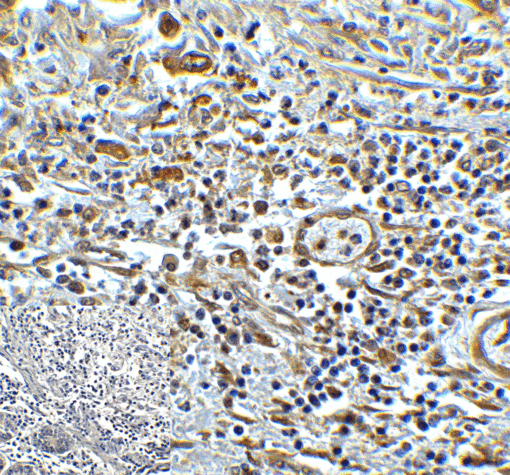 TMIGD2 Antibody - Immunohistochemistry of TMIGD2 in human colon carcinoma tissue with TMIGD2 antibody at 5 ug/mL.