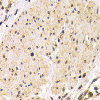 TMPRSS2 / Epitheliasin Antibody - Immunohistochemistry of paraffin-embedded human stomach cancer using TMPRSS2 antibody at dilution of 1:200 (400x lens).