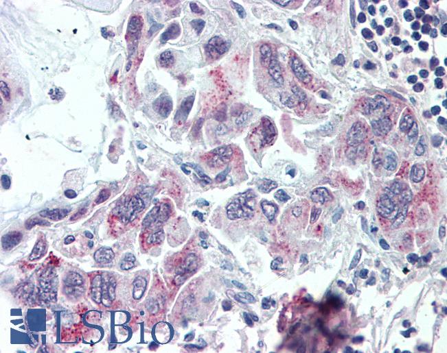 TMPRSS4 Antibody - Anti-TMPRSS4 antibody IHC of human Pancreas, Carcinoma. Immunohistochemistry of formalin-fixed, paraffin-embedded tissue after heat-induced antigen retrieval.