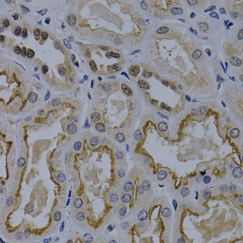 TNFRSF6B / DCR3 Antibody - Immunohistochemistry of paraffin-embedded human kidney cancer tissue at 1:200 dilution.