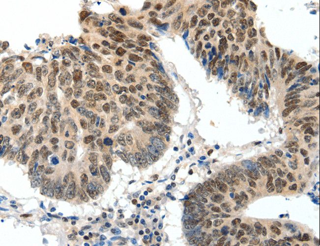 TOP2A / Topoisomerase II Alpha Antibody - Immunohistochemistry of paraffin-embedded Human ovarian cancer using TOP2A Polyclonal Antibody at dilution of 1:30.