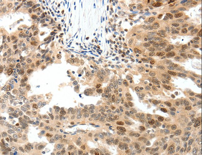 TOP2A / Topoisomerase II Alpha Antibody - Immunohistochemistry of paraffin-embedded Human ovarian cancer using TOP2A Polyclonal Antibody at dilution of 1:30.