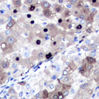 TOP2A / Topoisomerase II Alpha Antibody - Immunohistochemical analysis of Topoisomerase 2 alpha staining in human liver cancer formalin fixed paraffin embedded tissue section. The section was pre-treated using heat mediated antigen retrieval with sodium citrate buffer (pH 6.0). The section was then incubated with the antibody at room temperature and detected using an HRP conjugated compact polymer system. DAB was used as the chromogen. The section was then counterstained with hematoxylin and mounted with DPX.