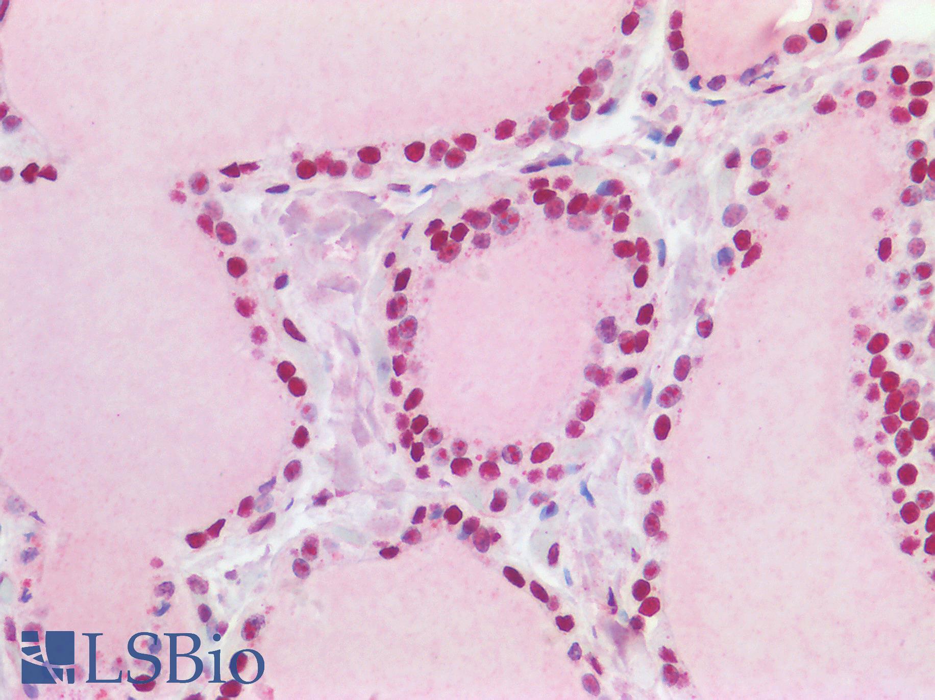 TP53BP1 / 53BP1 Antibody - Human Thyroid: Formalin-Fixed, Paraffin-Embedded (FFPE)