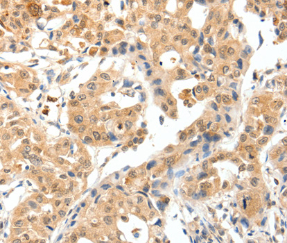 TPM2 Antibody - Immunohistochemistry of paraffin-embedded human lung cancer tissue.