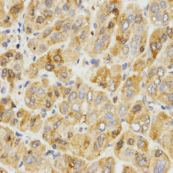 TPM2 Antibody - Immunohistochemistry of paraffin-embedded human liver cancer tissue.