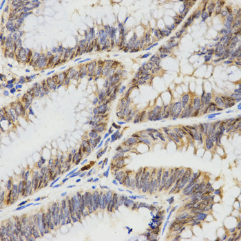 TPM2 Antibody - Immunohistochemistry of paraffin-embedded human rectal cancer tissue.