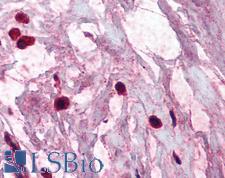 TPSAB1 / Mast Cell Tryptase Antibody - Anti-TPSAB1 / Mast Cell Tryptase antibody IHC of human breast, mast cells. Immunohistochemistry of formalin-fixed, paraffin-embedded tissue after heat-induced antigen retrieval. Antibody concentration 5 ug/ml.