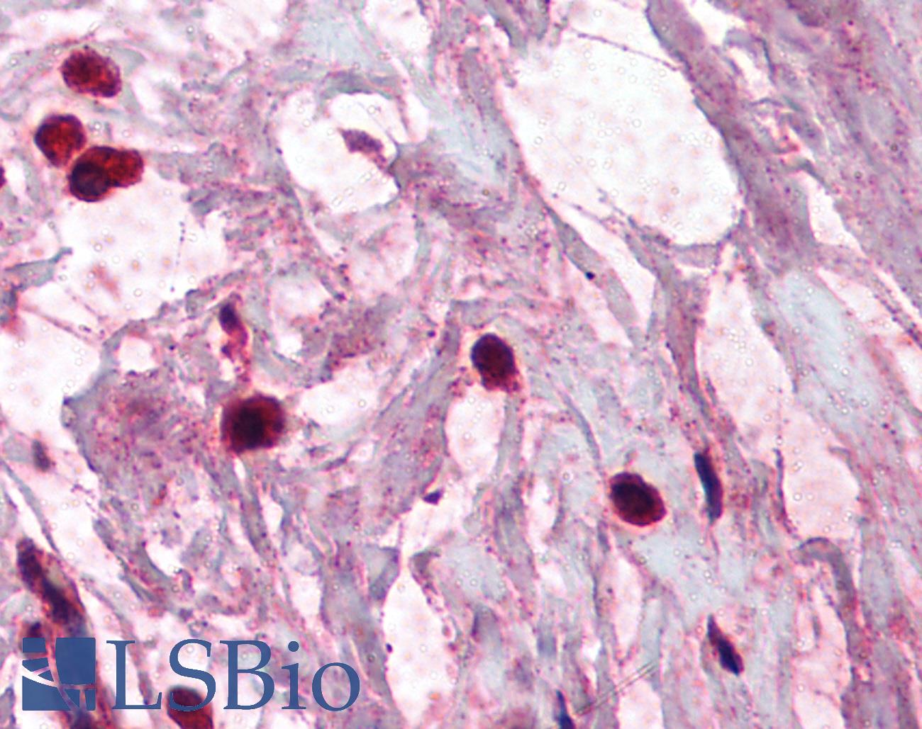 TPSAB1 / Mast Cell Tryptase Antibody - Anti-TPSAB1 / Mast Cell Tryptase antibody IHC of human breast, mast cells. Immunohistochemistry of formalin-fixed, paraffin-embedded tissue after heat-induced antigen retrieval. Antibody concentration 5 ug/ml.