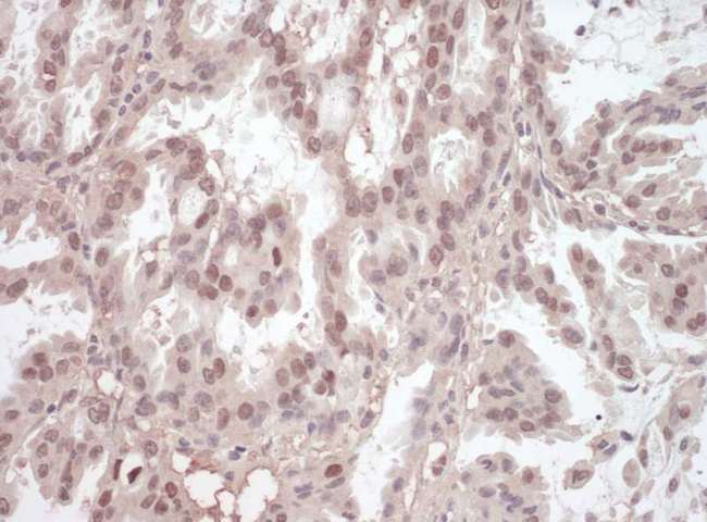 TRAF4 Antibody - Detection of Human TRAF4 by Immunohistochemistry. Sample: FFPE section of human lung carcinoma. Antibody: Affinity purified rabbit anti-TRAF4 used at a dilution of 1:1000 (1 ug/ml). Detection: Vector Laboratories ImmPACT NovaRED Peroxidase Substrate.