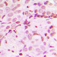 Treacle / TCOF1 Antibody - Immunohistochemical analysis of TCOF1 staining in human breast cancer formalin fixed paraffin embedded tissue section. The section was pre-treated using heat mediated antigen retrieval with sodium citrate buffer (pH 6.0). The section was then incubated with the antibody at room temperature and detected using an HRP-conjugated compact polymer system. DAB was used as the chromogen. The section was then counterstained with hematoxylin and mounted with DPX.