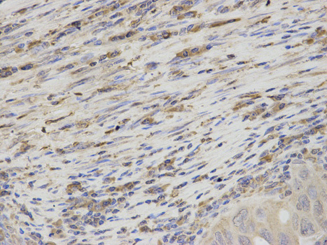 TS / Thromboxane Synthase Antibody - Immunohistochemistry of paraffin-embedded human endometrial cancer using TBXAS1 antibody at dilution of 1:200 (400x lens).