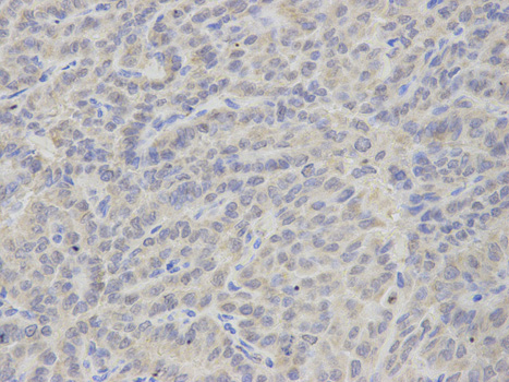 TS / Thromboxane Synthase Antibody - Immunohistochemistry of paraffin-embedded human thyroid cancer using TBXAS1 antibody at dilution of 1:200 (400x lens).