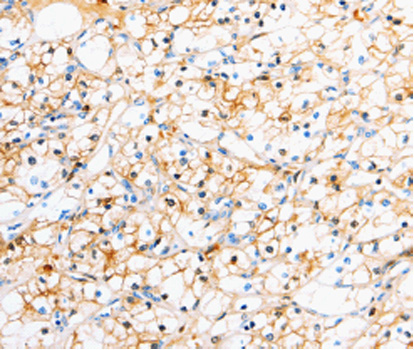 TTR / Transthyretin Antibody - Immunohistochemistry of paraffin-embedded human renal cancer tissue.