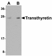 TTR / Transthyretin Antibody - Western blot of Transthyretin in human lung tissue lysate with Transthyretin antibody at (A) 1 and (B) 2 ug/ml. Below: Immunohistochemistry of Transthyretin in human lung tissue with Transthyretin antibody at 2.5 ug/ml.
