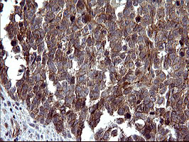 TUBB1 / Tubulin Beta 1 Antibody - IHC of paraffin-embedded Adenocarcinoma of Human colon tissue using anti-TUBB1 mouse monoclonal antibody. (Heat-induced epitope retrieval by 10mM citric buffer, pH6.0, 120°C for 3min), at a dilution of 1:150.