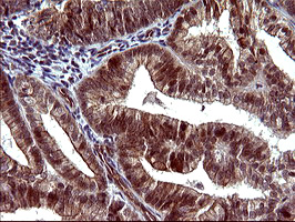 TUBB1 / Tubulin Beta 1 Antibody - IHC of paraffin-embedded Adenocarcinoma of Human endometrium tissue using anti-TUBB1 mouse monoclonal antibody. (Heat-induced epitope retrieval by 10mM citric buffer, pH6.0, 120°C for 3min), at a dilution of 1:150.