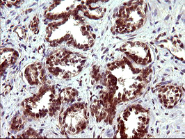 TUBB1 / Tubulin Beta 1 Antibody - IHC of paraffin-embedded Carcinoma of Human prostate tissue using anti-TUBB1 mouse monoclonal antibody. (Heat-induced epitope retrieval by 10mM citric buffer, pH6.0, 120°C for 3min), at a dilution of 1:150.