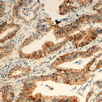TUSC3 Antibody - Immunohistochemical analysis of TUSC3 staining in human colon cancer formalin fixed paraffin embedded tissue section. The section was pre-treated using heat mediated antigen retrieval with sodium citrate buffer (pH 6.0). The section was then incubated with the antibody at room temperature and detected using an HRP conjugated compact polymer system. DAB was used as the chromogen. The section was then counterstained with hematoxylin and mounted with DPX.