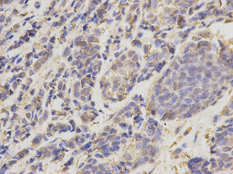 UBE2I / UBC9 Antibody - Immunohistochemistry of paraffin-embedded human breast cancer using UBE2I antibody at dilution of 1:200 (400x lens).