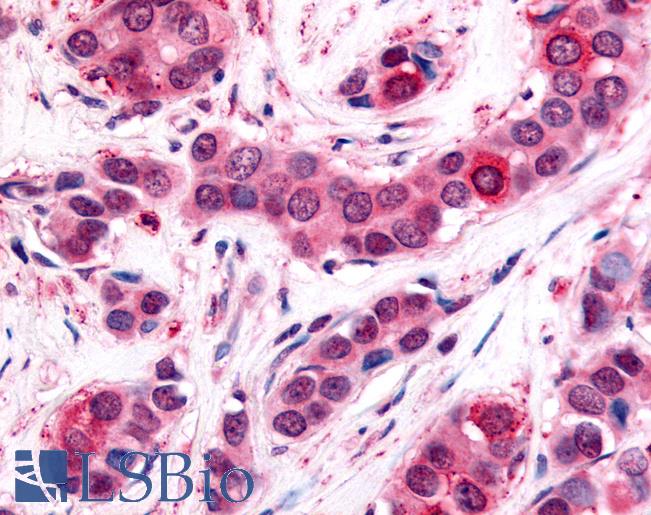 UCHL3 Antibody - Anti-UCHL3 antibody IHC of human Breast, Carcinoma. Immunohistochemistry of formalin-fixed, paraffin-embedded tissue after heat-induced antigen retrieval.