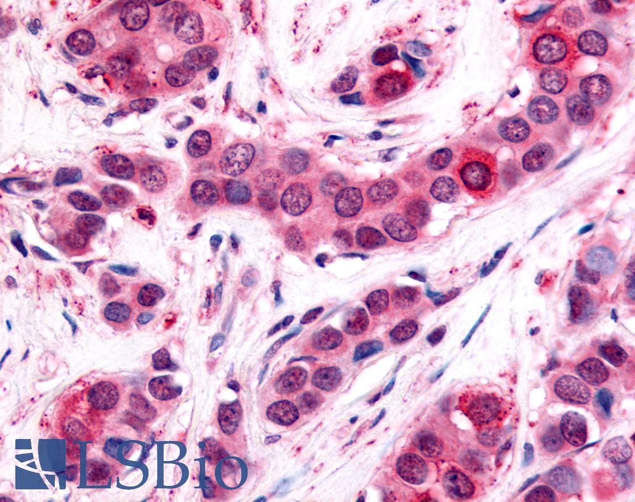 UCHL3 Antibody - Anti-UCHL3 antibody IHC of human Breast, Carcinoma. Immunohistochemistry of formalin-fixed, paraffin-embedded tissue after heat-induced antigen retrieval.