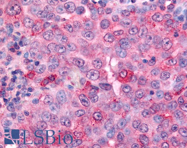 UCHL3 Antibody - Anti-UCHL3 antibody IHC of human Lung, Non-Small Cell Carcinoma. Immunohistochemistry of formalin-fixed, paraffin-embedded tissue after heat-induced antigen retrieval.