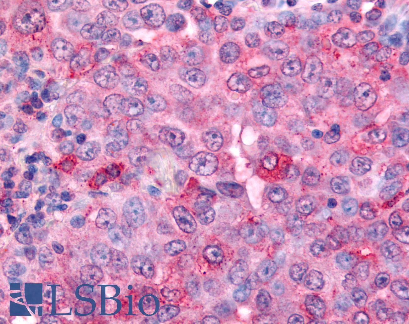 UCHL3 Antibody - Anti-UCHL3 antibody IHC of human Lung, Non-Small Cell Carcinoma. Immunohistochemistry of formalin-fixed, paraffin-embedded tissue after heat-induced antigen retrieval.