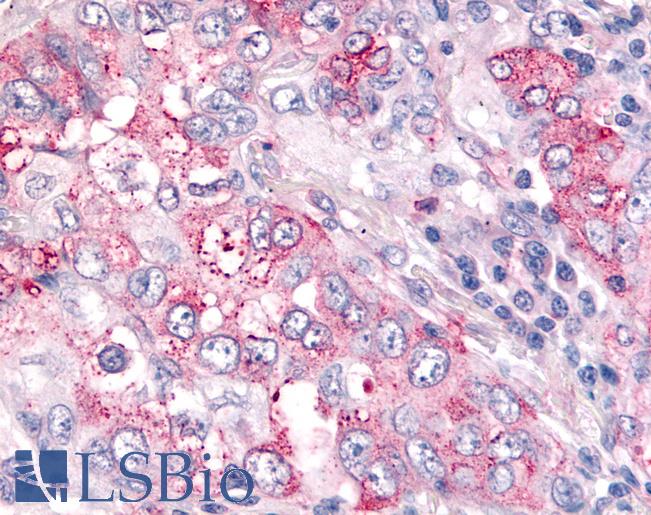 USP4 Antibody - Anti-USP4 / UNP antibody IHC of human Lung, Non-Small Cell Carcinoma. Immunohistochemistry of formalin-fixed, paraffin-embedded tissue after heat-induced antigen retrieval.