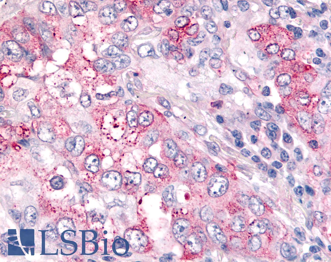 USP4 Antibody - Anti-USP4 / UNP antibody IHC of human Lung, Non-Small Cell Carcinoma. Immunohistochemistry of formalin-fixed, paraffin-embedded tissue after heat-induced antigen retrieval.